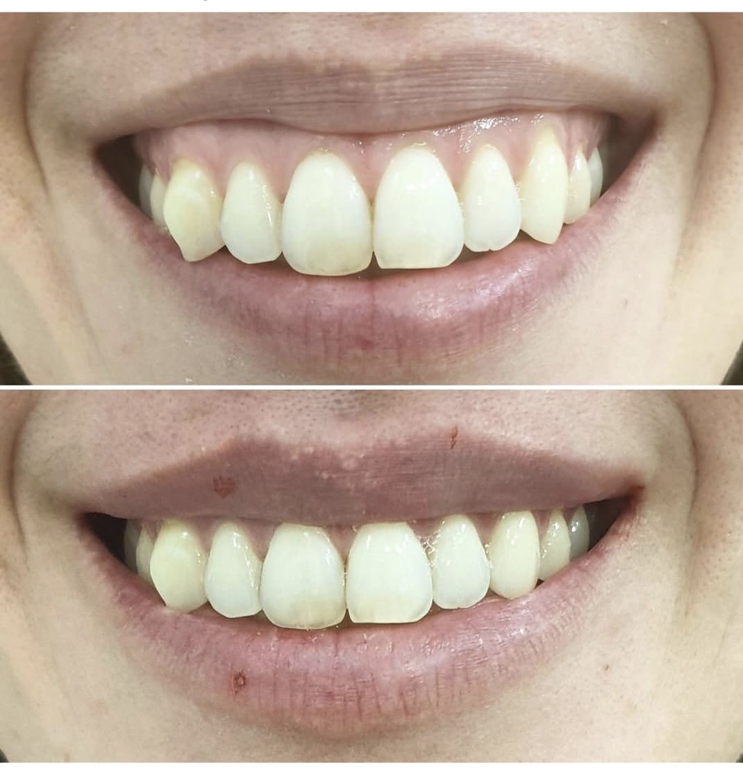 Tratamiento de la sonrisa gingival en Catarroja