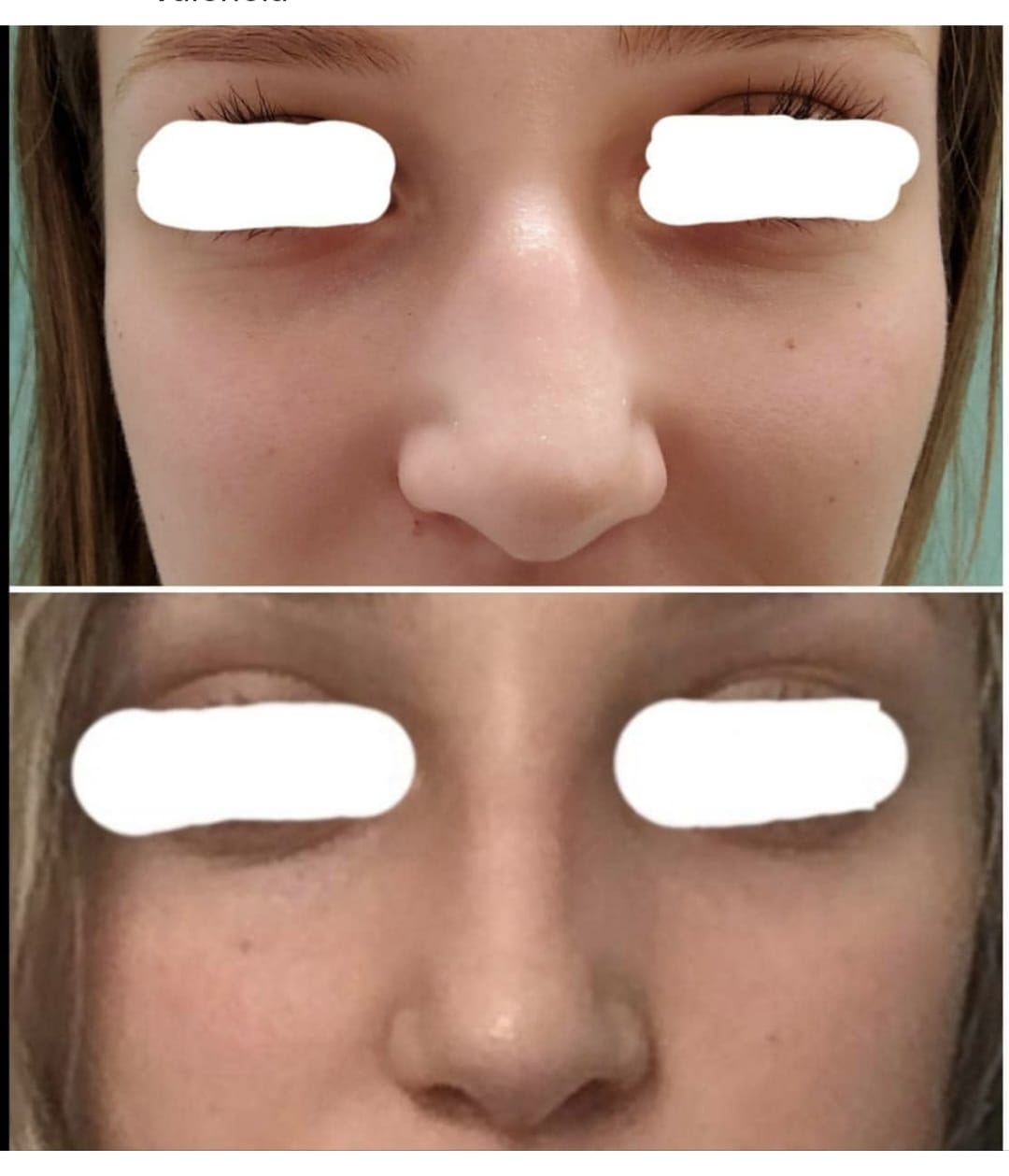Armonización facial y rinomodelación con ácido hialurónico