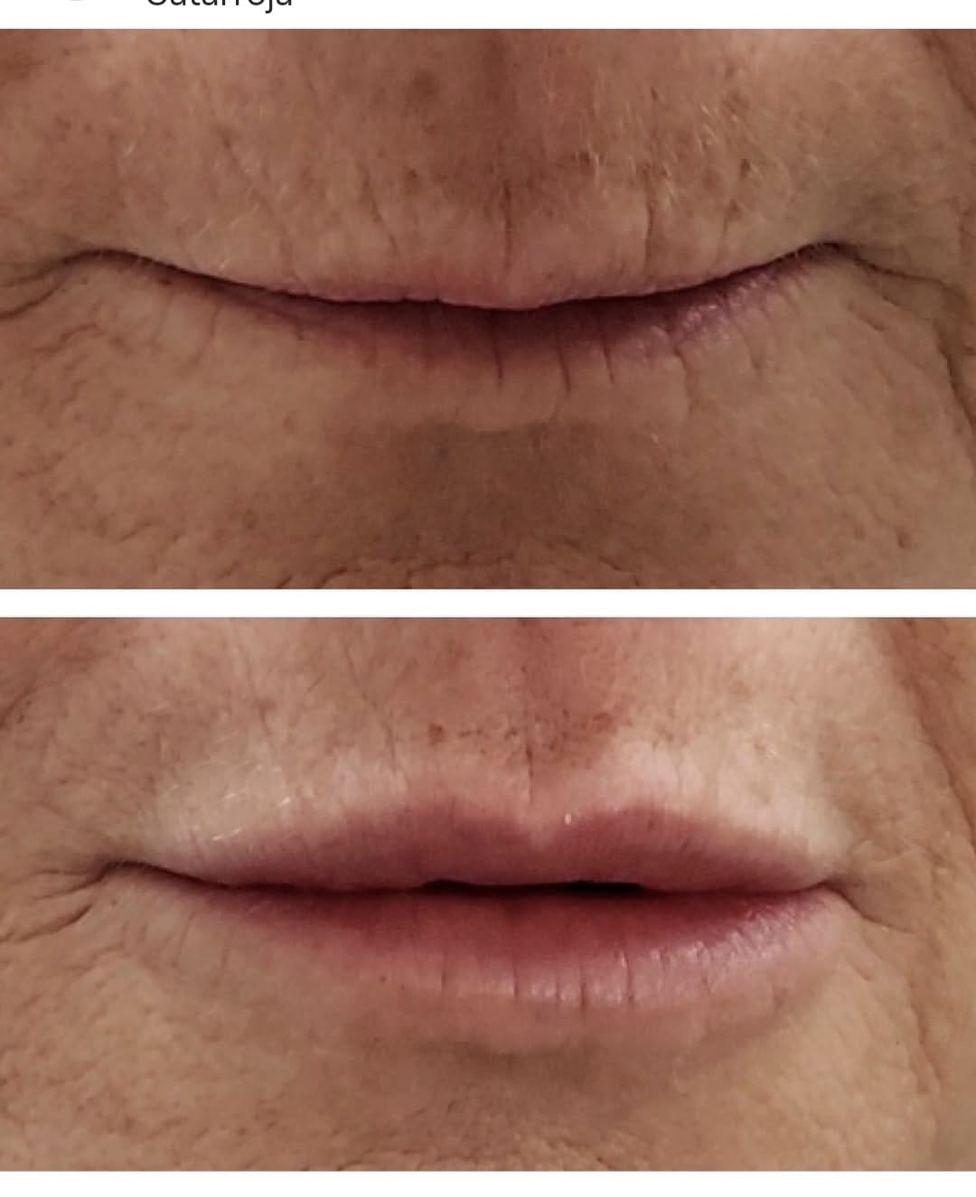 Revitalización facial y rejuvenecimiento perioral