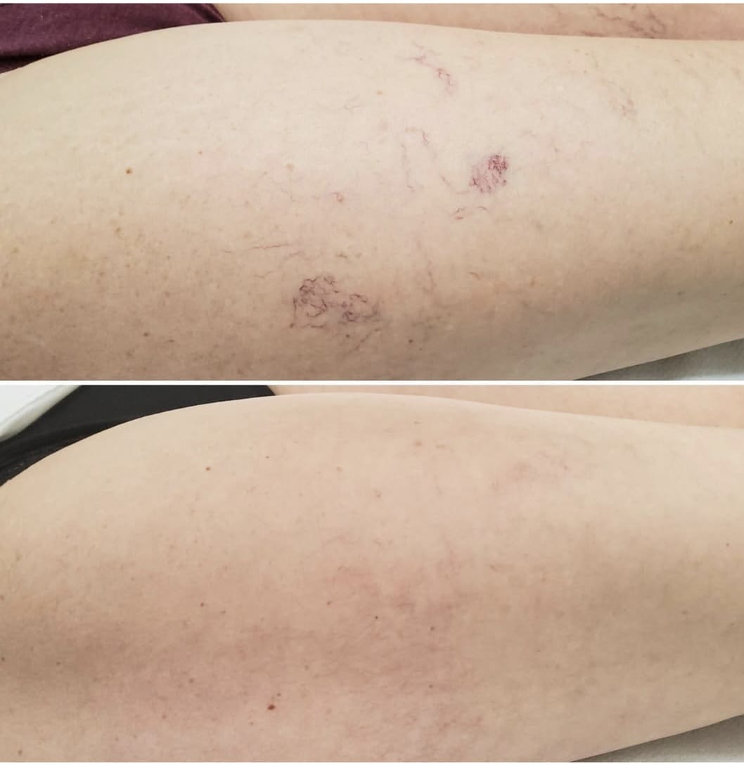 Tratamiento de varices y arañas vasculares con esclerosis vascular en Catarroja