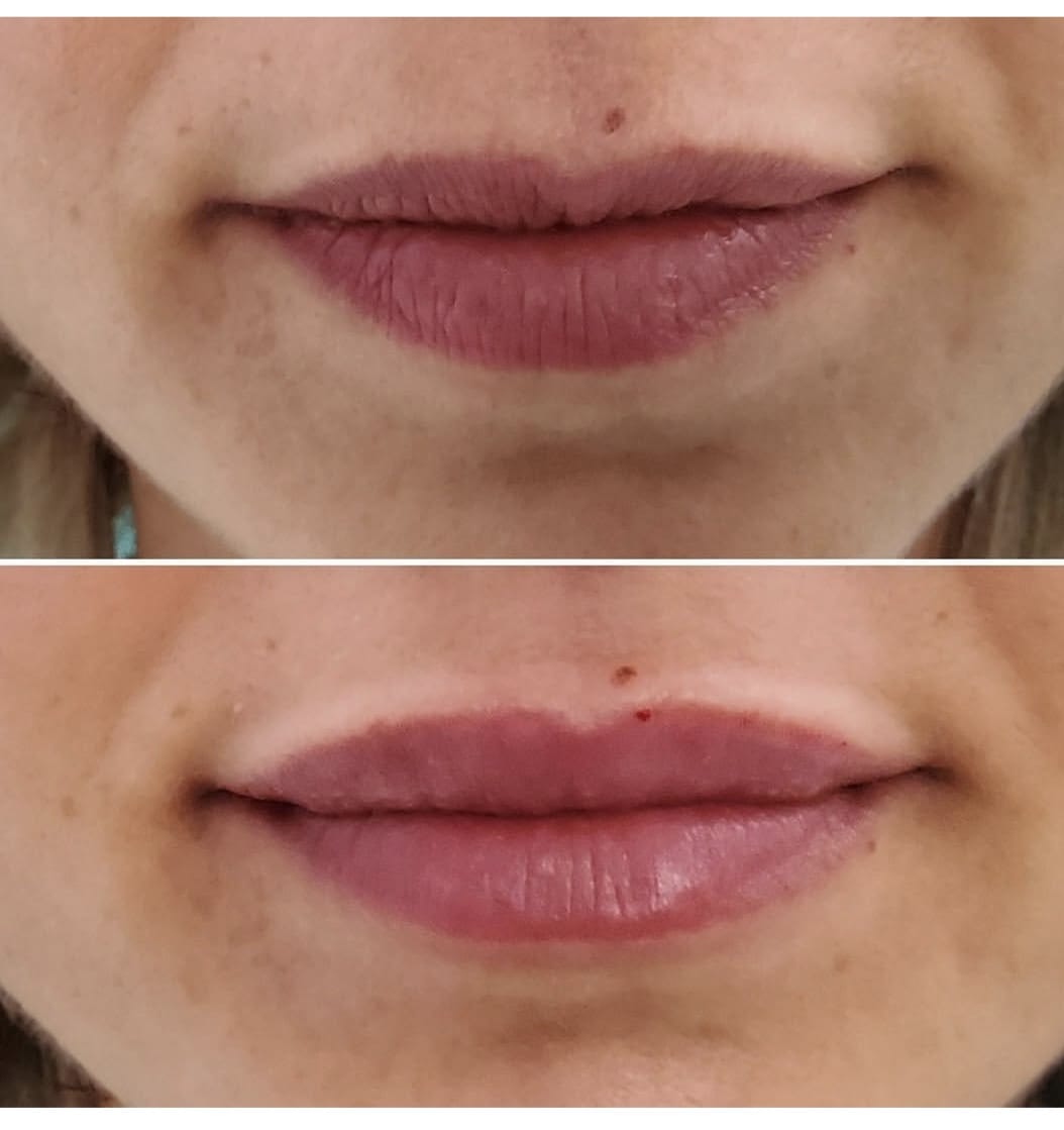 Aumento de labios con ácido hialurónico